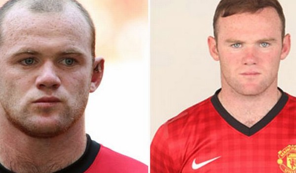 wayne rooney hair transplant before and after